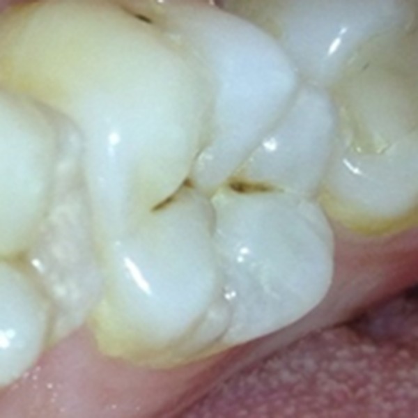 Icdas II criteria (international caries detection and assessment system).