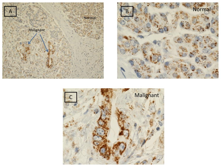 Soluble gC1qR in Blood and Body Fluids: Examination in a Pancreatic Cancer Patient Cohort.