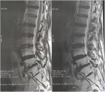 Lumbosacral plexopathy: A rare long term complication of concomitant chemo-radiation for cervical cancer.