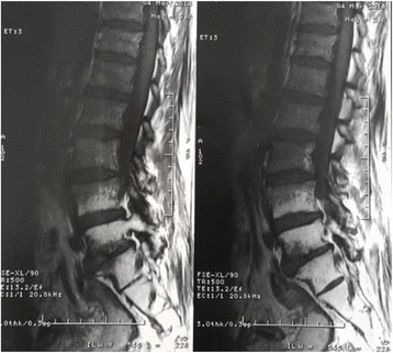 Lumbosacral plexopathy: A rare long term complication of concomitant chemo-radiation for cervical cancer.