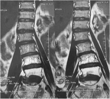 Lumbosacral plexopathy: A rare long term complication of concomitant chemo-radiation for cervical cancer.