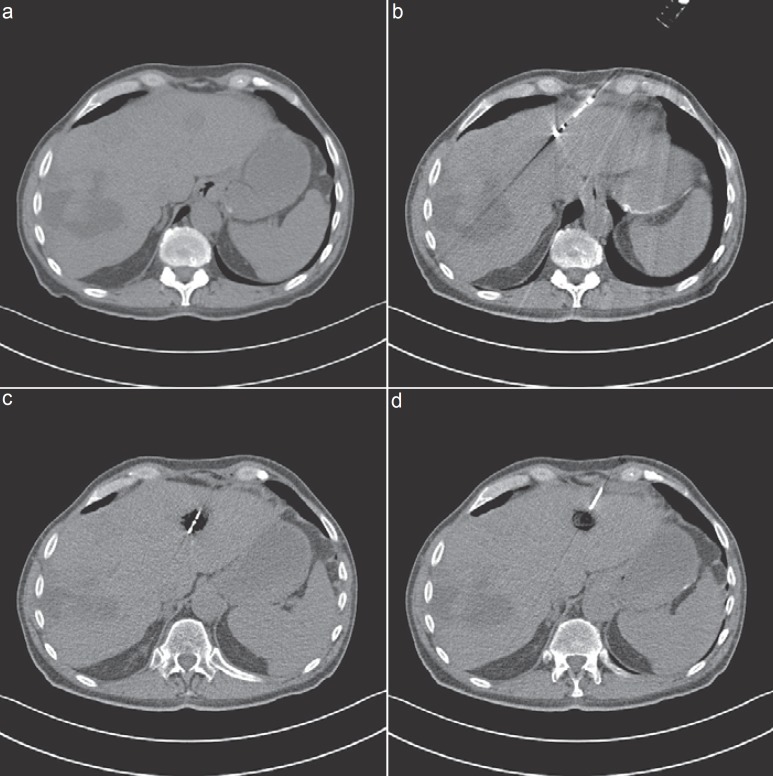 How Effective Are Percutaneous Liver-Directed Therapies in Patients with Non-Colorectal Liver Metastases?
