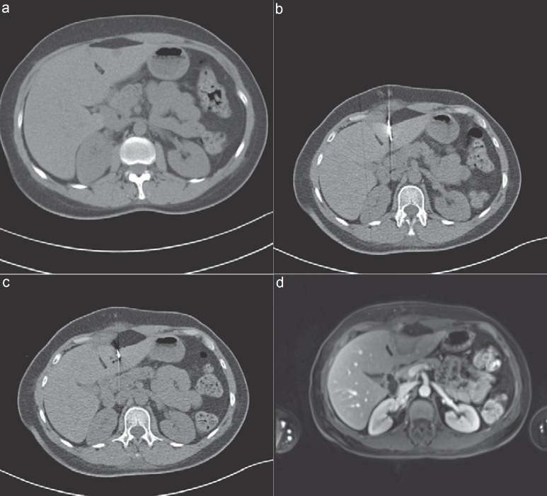 How Effective Are Percutaneous Liver-Directed Therapies in Patients with Non-Colorectal Liver Metastases?