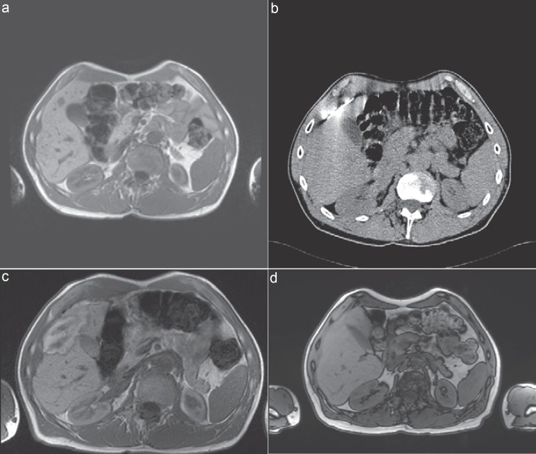 How Effective Are Percutaneous Liver-Directed Therapies in Patients with Non-Colorectal Liver Metastases?