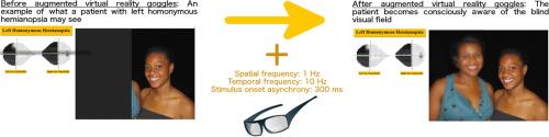 Enhancing visual performance in individuals with cortical visual impairment (homonymous hemianopsia): Tapping into blindsight