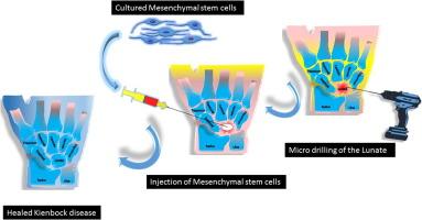 Mesenchymal stem cells injection with core decompression in the treatment of Kienbock disease