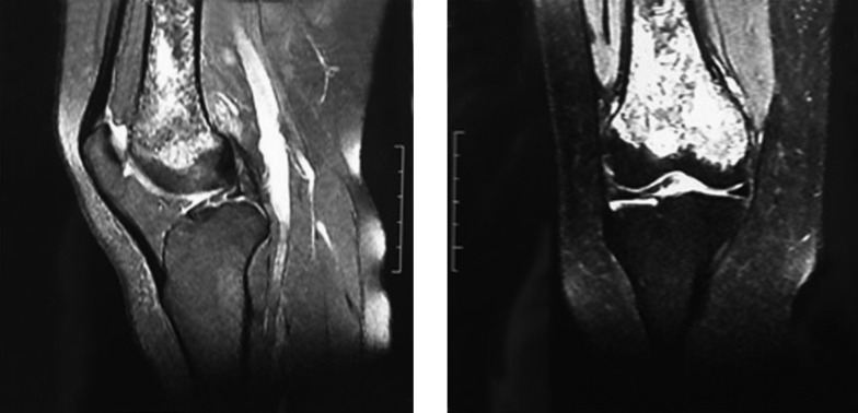 Primary intraosseous hydatid cyst of femur.