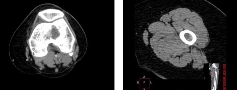 Primary intraosseous hydatid cyst of femur.