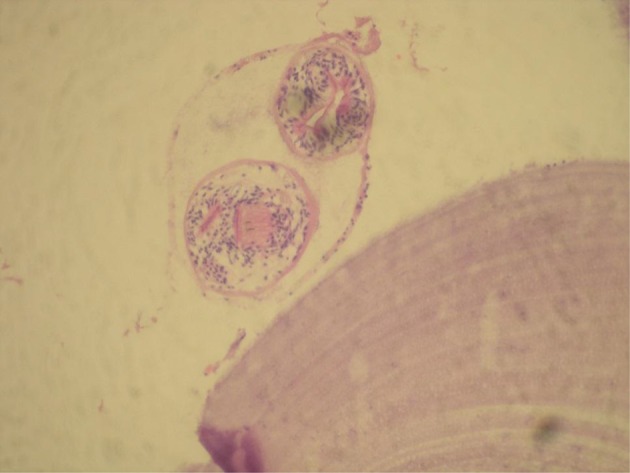 Primary intraosseous hydatid cyst of femur.