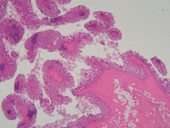 Giant Filiform Polyposis not Associated with Inflammatory Bowel Disease: A Case Report.