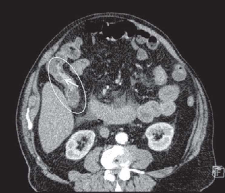 Giant Filiform Polyposis not Associated with Inflammatory Bowel Disease: A Case Report.