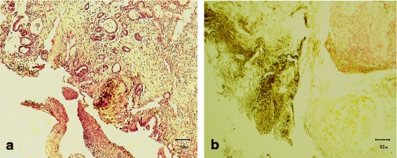 Primary gastric actinomycosis: report of a case diagnosed in a gastroscopic biopsy.