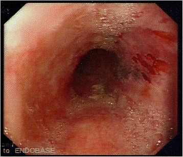 Primary gastric actinomycosis: report of a case diagnosed in a gastroscopic biopsy.