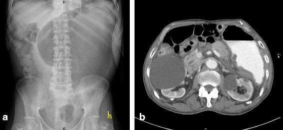 Primary gastric actinomycosis: report of a case diagnosed in a gastroscopic biopsy.