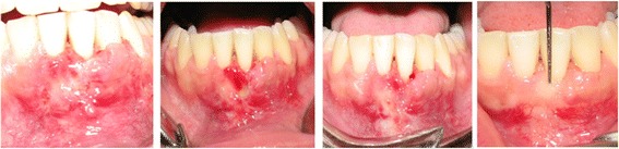 Bone-added periodontal plastic surgery: a new approach in esthetic dentistry.