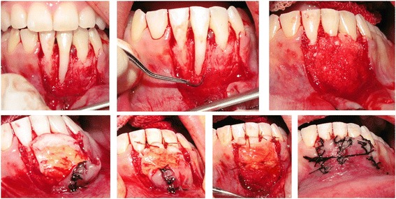 Bone-added periodontal plastic surgery: a new approach in esthetic dentistry.