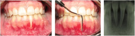 Bone-added periodontal plastic surgery: a new approach in esthetic dentistry.