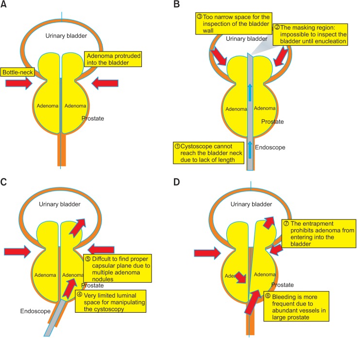 Efficacy and safety of holmium laser enucleation of the prostate for extremely large prostatic adenoma in patients with benign prostatic hyperplasia.