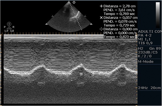 Point-of-care ultrasound of the diaphragm in a liver transplant patient with acute respiratory failure.