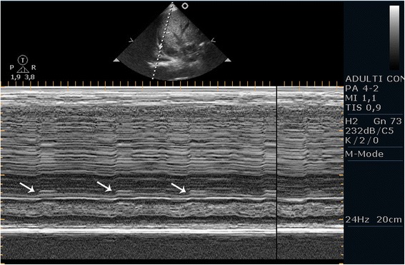 Point-of-care ultrasound of the diaphragm in a liver transplant patient with acute respiratory failure.