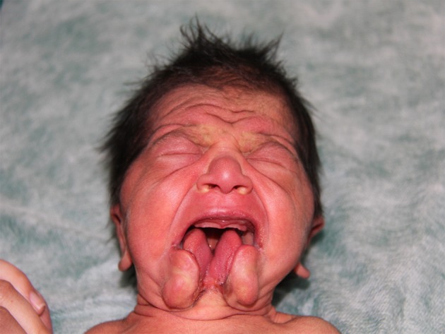 Tessier number 30 clefts with congenital heart defects.