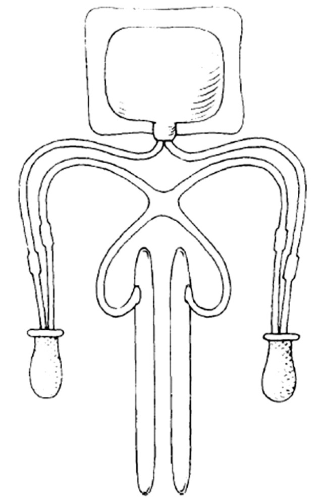 Evolution of penile prosthetic devices.