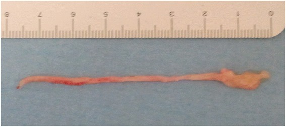 Recurrent lung atelectasis from fibrin plugs as a very early complication of bronchial thermoplasty: a case report.