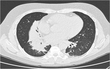 Recurrent lung atelectasis from fibrin plugs as a very early complication of bronchial thermoplasty: a case report.