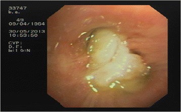 Recurrent lung atelectasis from fibrin plugs as a very early complication of bronchial thermoplasty: a case report.