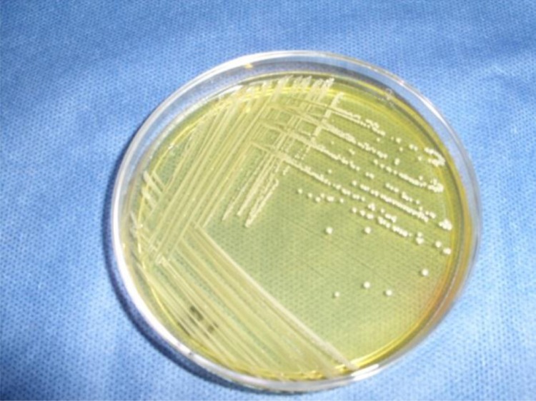 Staphylococcus aureus small colony variants in diabetic foot infections.