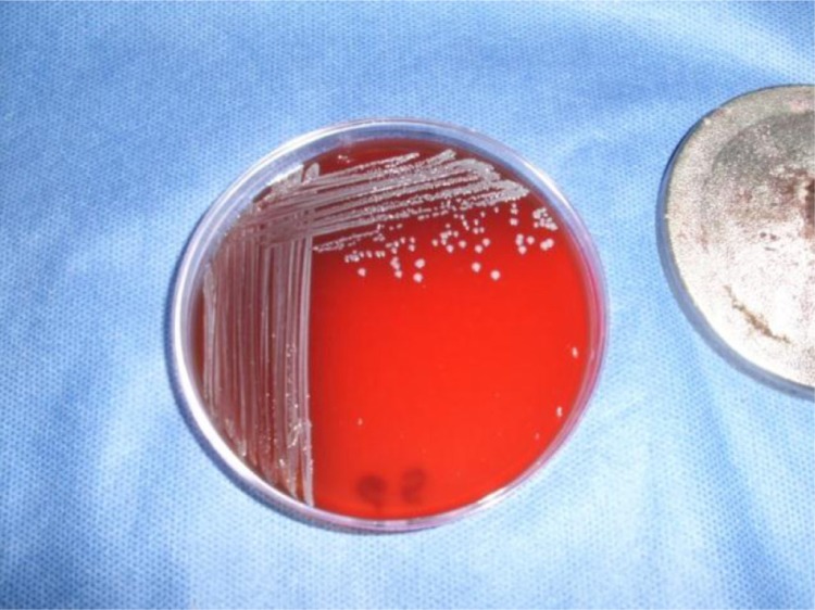 Staphylococcus aureus small colony variants in diabetic foot infections.