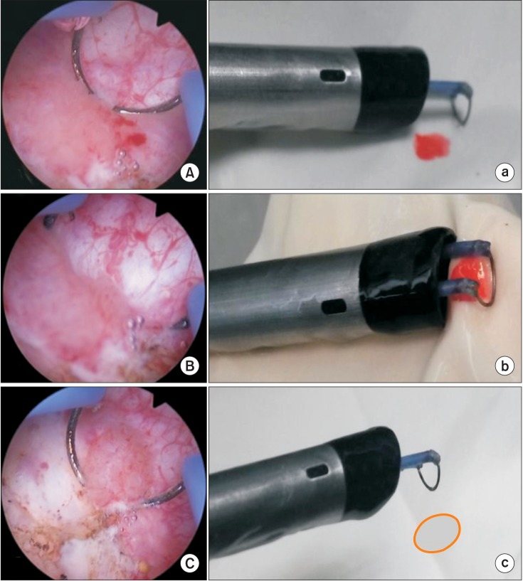 A novel transurethral resection technique for superficial flat bladder tumor: grasp and bite technique.