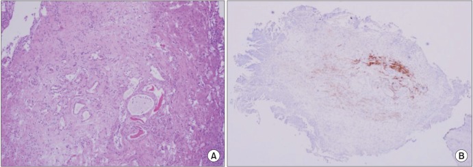 A novel transurethral resection technique for superficial flat bladder tumor: grasp and bite technique.