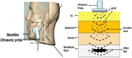 Transdermal bFGF delivery using low-frequency sonophoresis: An innovative potential therapy for osteoradionecrosis of jaws