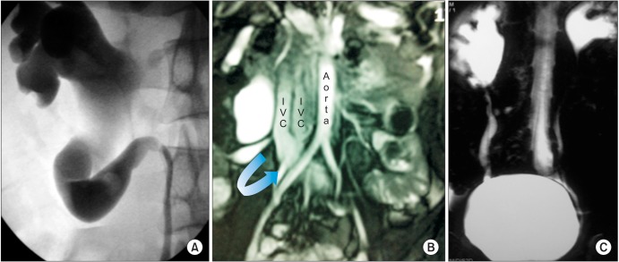 Right sided double inferior vena cava with obstructed retrocaval ureter: Managed with single incision multiple port laparoscopic technique using "Santosh Postgraduate Institute tacking ureteric fixation technique".