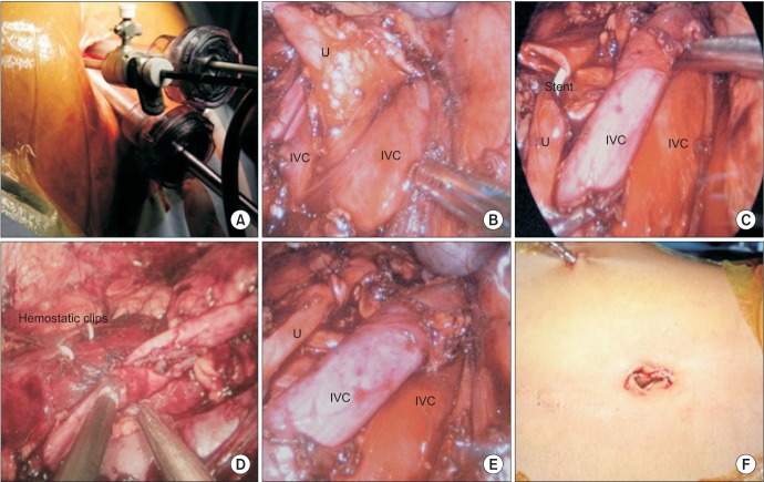 Right sided double inferior vena cava with obstructed retrocaval ureter: Managed with single incision multiple port laparoscopic technique using "Santosh Postgraduate Institute tacking ureteric fixation technique".