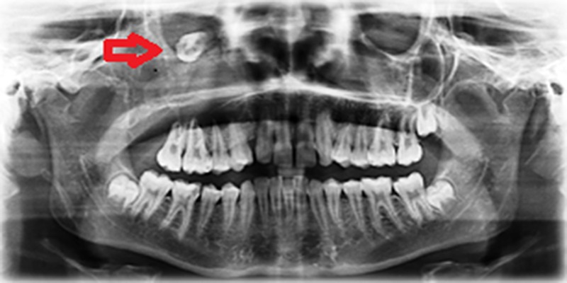 Large dentigerous cyst in the maxillary sinus leading to diplopia and nasal obstruction: case report.