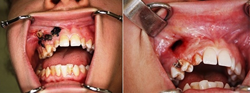 Large dentigerous cyst in the maxillary sinus leading to diplopia and nasal obstruction: case report.