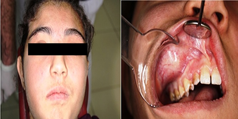 Large dentigerous cyst in the maxillary sinus leading to diplopia and nasal obstruction: case report.