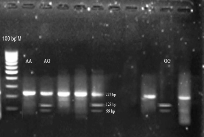 SULF 1 gene polymorphism, rs6990375 is in significant association with fetus failure in IVF technique.