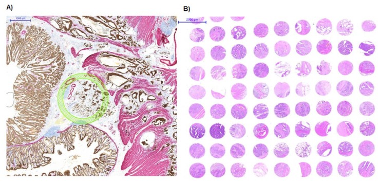 Tissue Microarray Technology for Molecular Applications: Investigation of Cross-Contamination between Tissue Samples Obtained from the Same Punching Device.