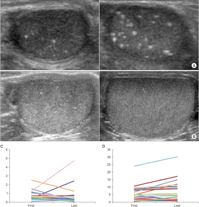 Changes of calcific density in pediatric patients with testicular microlithiasis.