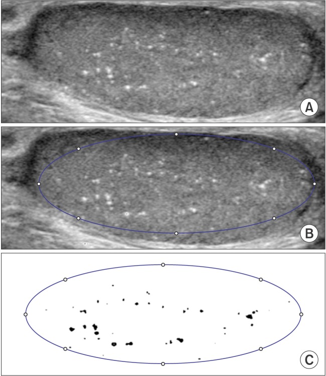 Changes of calcific density in pediatric patients with testicular microlithiasis.