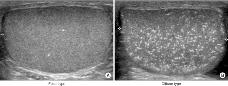 Changes of calcific density in pediatric patients with testicular microlithiasis.