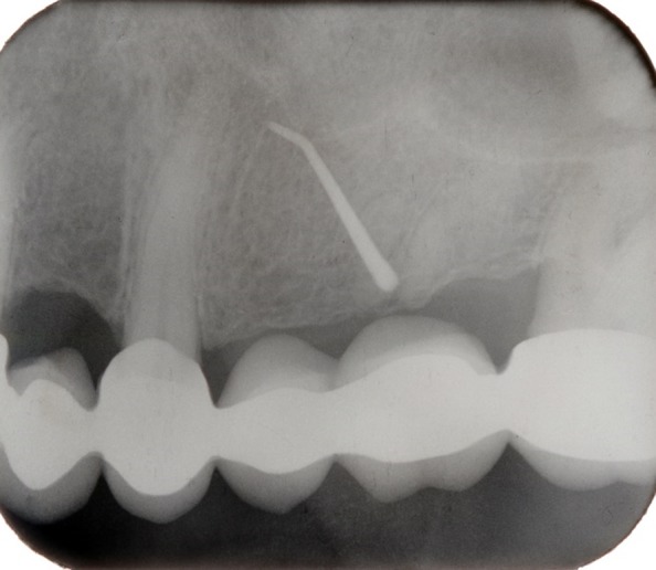 Treatment of extraoral cutaneous sinus tracts with non-surgical endodontic intervention: report of six cases.