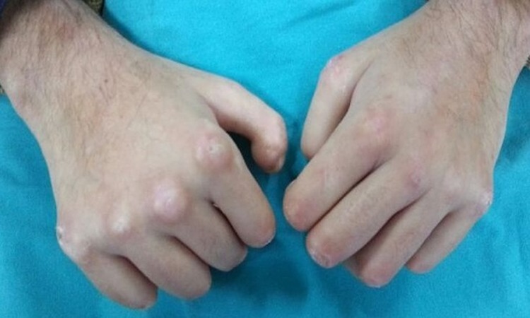 Scleroderma: a case report.