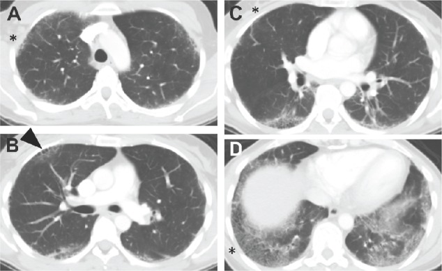 Normalization of lung function following treatment of secondary usual interstitial pneumonia: a case report.