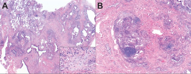 Normalization of lung function following treatment of secondary usual interstitial pneumonia: a case report.