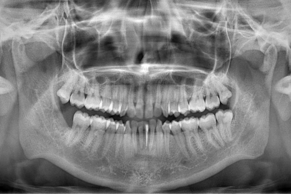 Deep neck infection after third molar extraction.