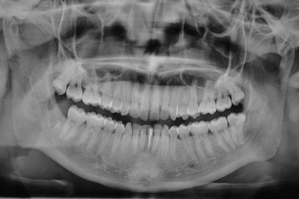 Deep neck infection after third molar extraction.